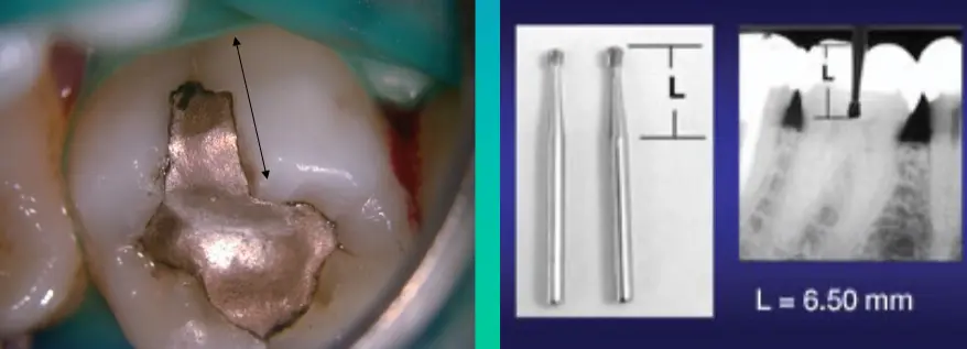Access for Root Canal Treatment-1764839779226.webp