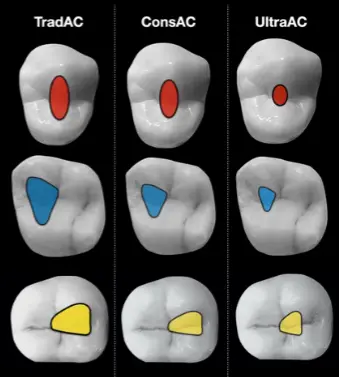 Access for Root Canal Treatment-1764840272969.webp