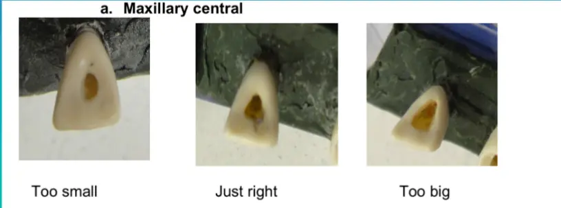 Access for Root Canal Treatment-1764841127190.webp542x201