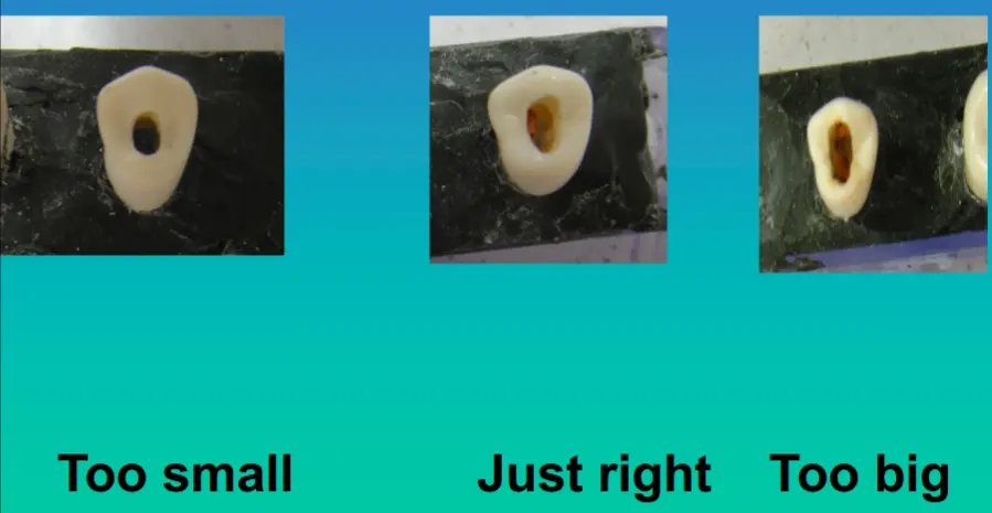Access for Root Canal Treatment-1764841141133.webp523x271