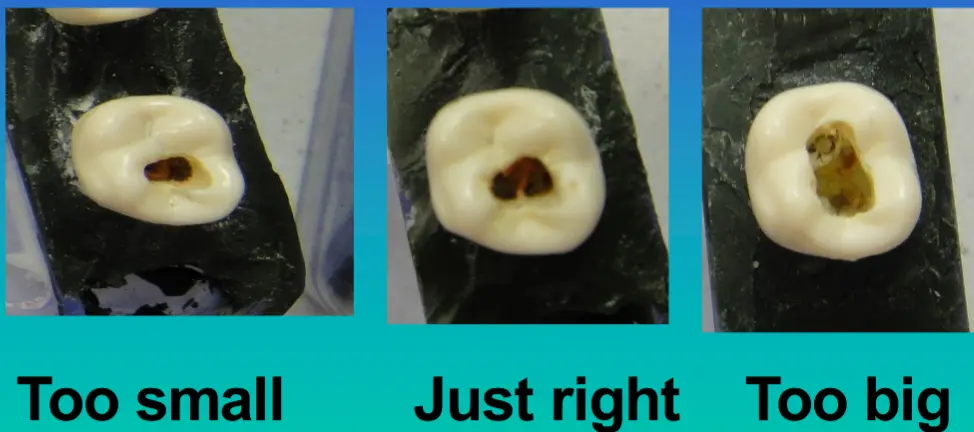 Access for Root Canal Treatment-1764841163039.webp607x269