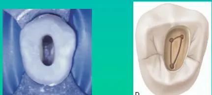 Access for Root Canal Treatment-1764841243770.webp