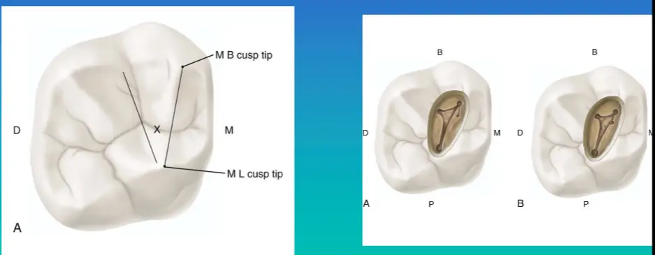 Access for Root Canal Treatment-1764841566500.webp551x215