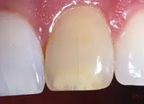 Bleaching of Endodontically Treated Teeth-1765464999635.webp