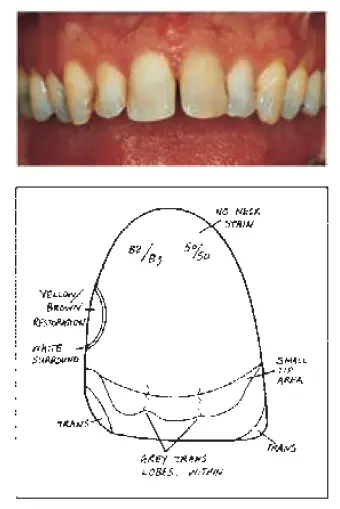 Clinical technique for making crowns-1781366374917.webp