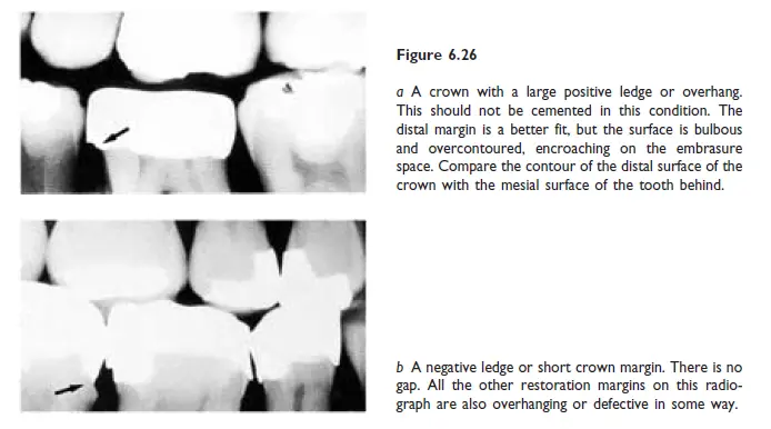 Clinical technique for making crowns-1781367920902.webp