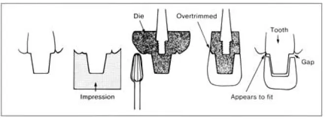 Clinical technique for making crowns-1781370239034.webp