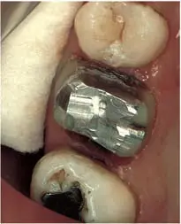 Crown Preparation Design-1780818688496.webp