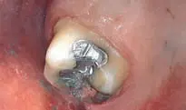 Crown Preparation Design-1780818798424.webp