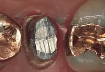 Crown Preparation Design-1780818801652.webp