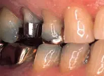 Crown Preparation Design-1780818806127.webp