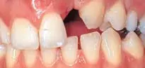 Crown Preparation Design-1780818846633.webp