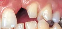 Crown Preparation Design-1780818848278.webp