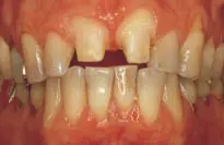 Crown Preparation Design-1780818856293.webp
