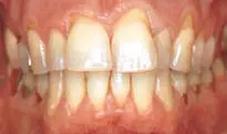 Crown Preparation Design-1780818867481.webp