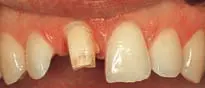 Crown Preparation Design-1780818897958.webp