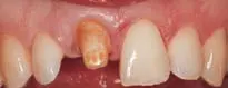 Crown Preparation Design-1780818911669.webp