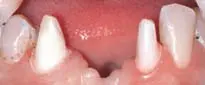 Crown Preparation Design-1780818967103.webp