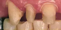 Crown Preparation Design-1780818975660.webp