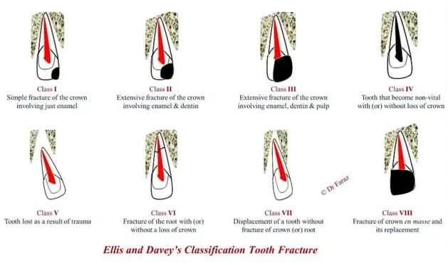 Dentoalveolar Trauma 1-1765268402495.webp