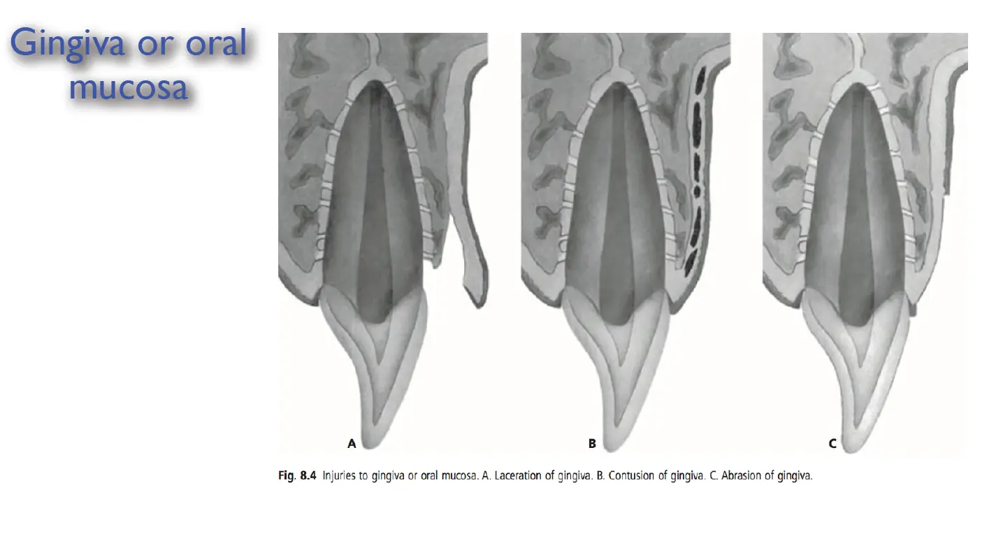 Dentoalveolar Trauma 1-1765268693701.webp