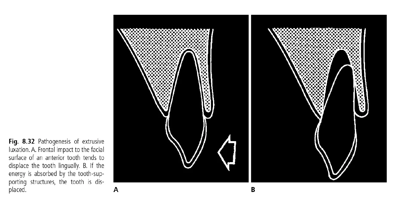 Dentoalveolar Trauma 1-1765268851859.webp