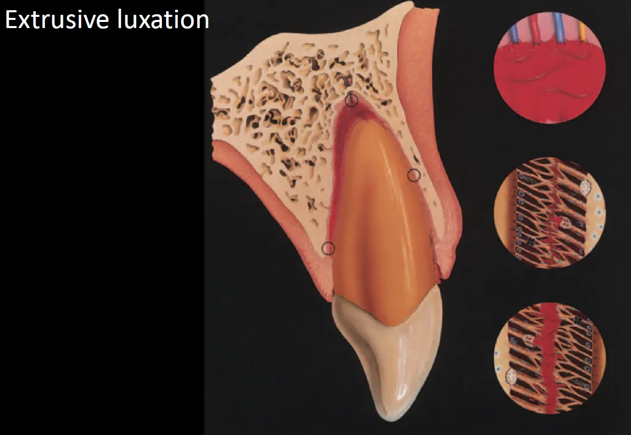 Dentoalveolar Trauma 1-1765346954429.webp