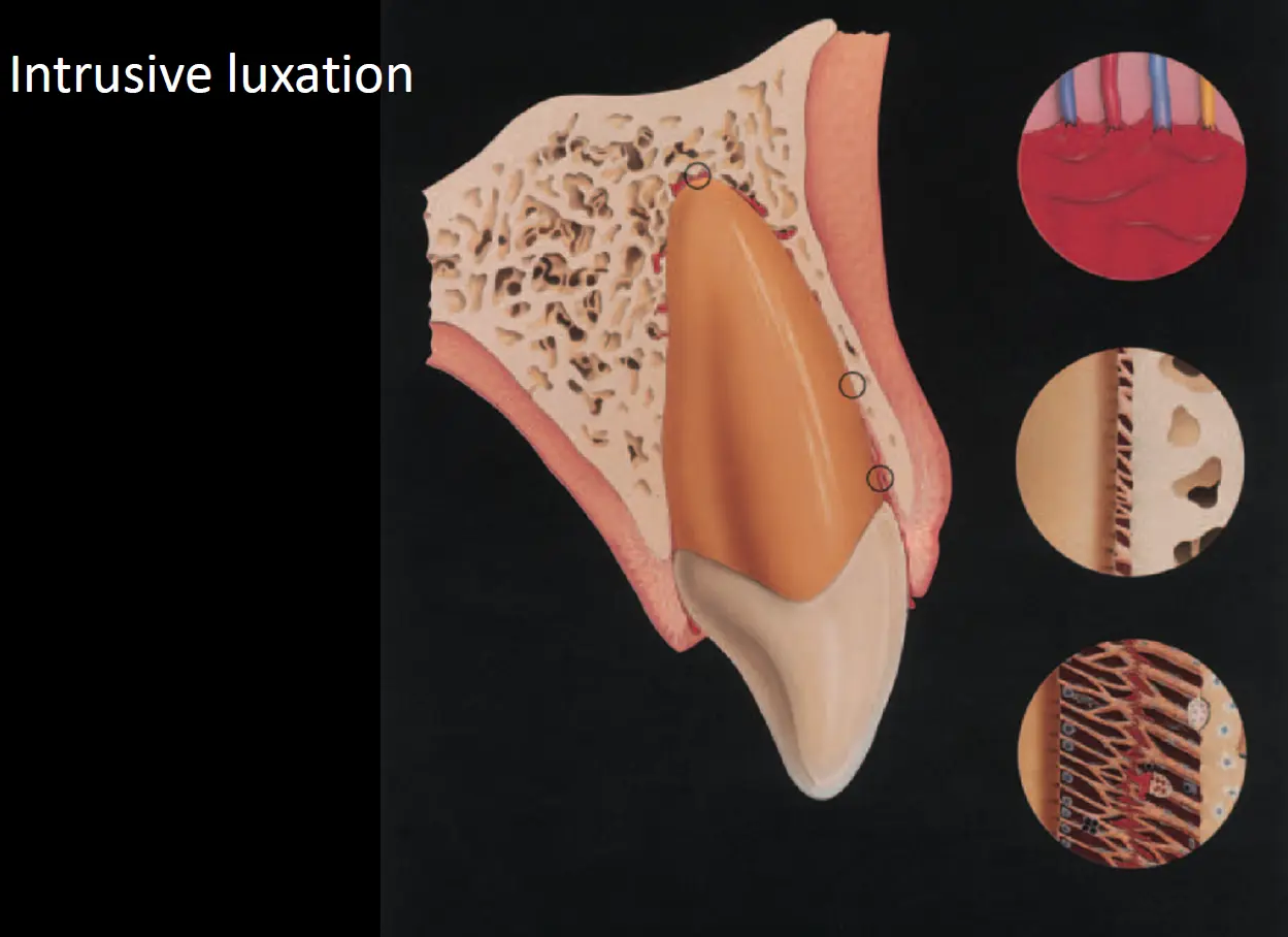Dentoalveolar Trauma 1-1765347663295.webp607x441