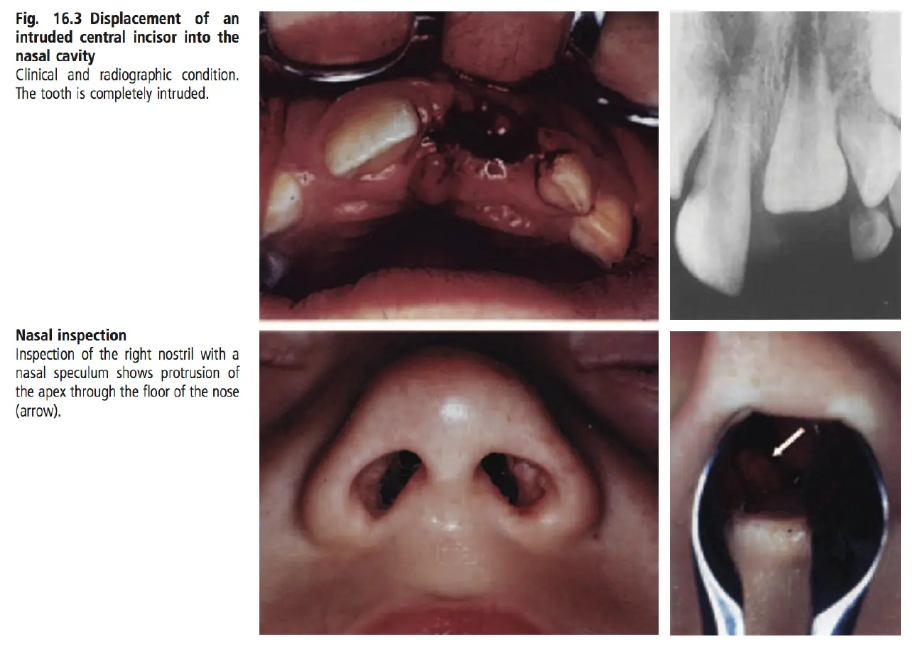 Dentoalveolar Trauma 1-1765347678609.webp601x427