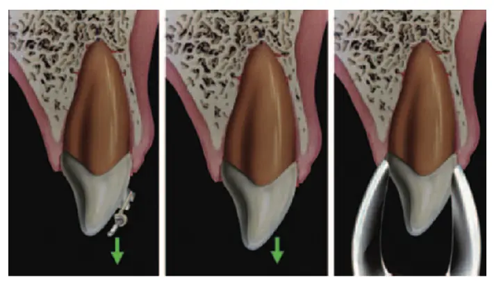 Dentoalveolar Trauma 1-1765348086323.webp