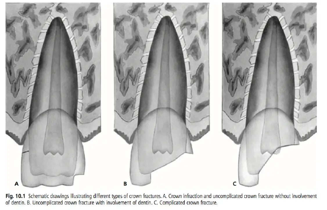Dentoalveolar Trauma 1-1765348365906.webp