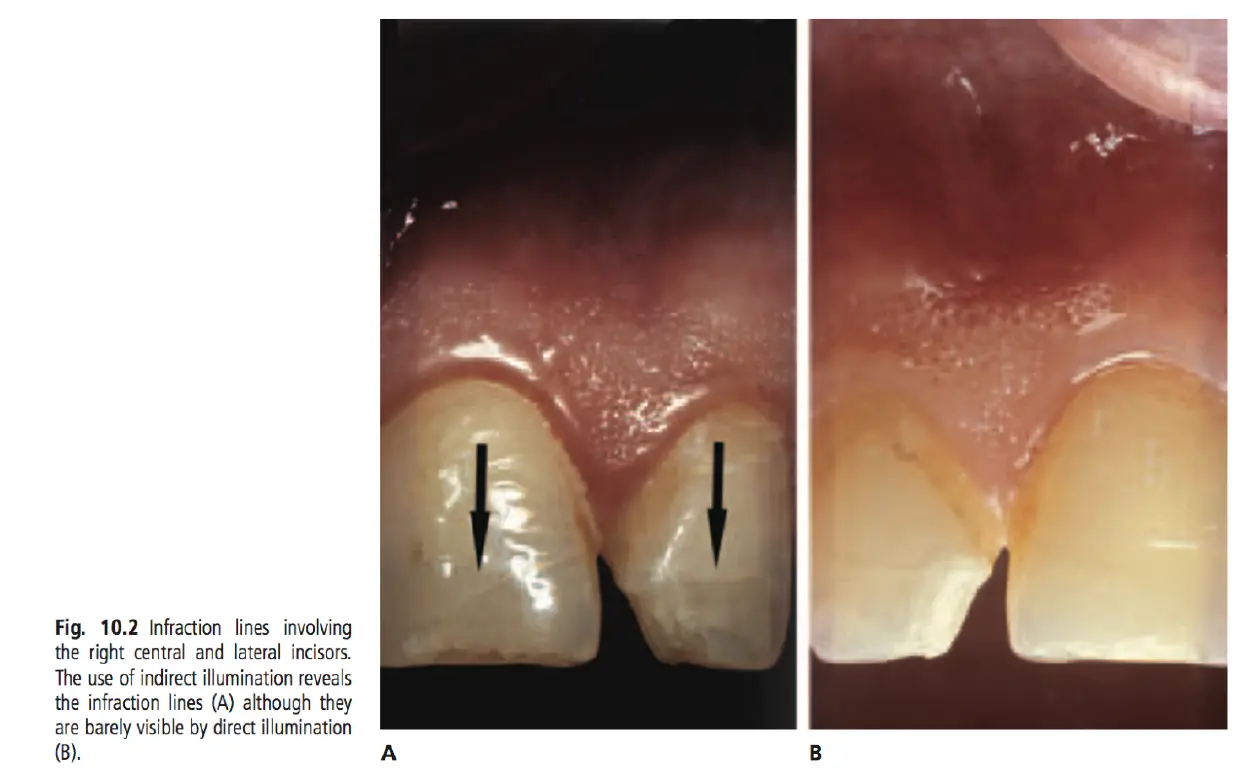 Dentoalveolar Trauma 1-1765348437451.webp