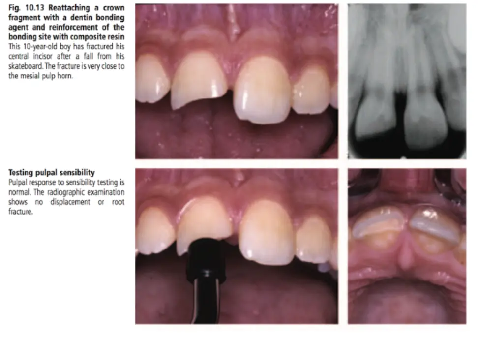Dentoalveolar Trauma 1-1765348846859.webp