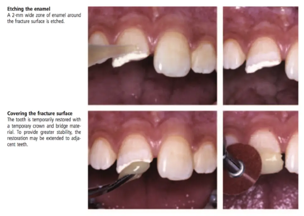 Dentoalveolar Trauma 1-1765348858619.webp