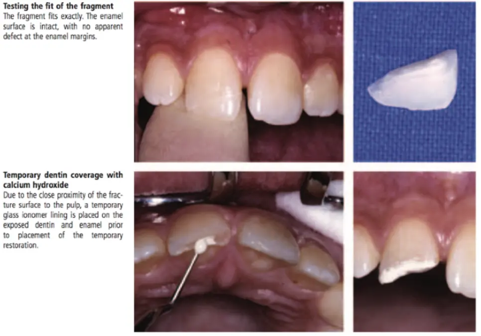 Dentoalveolar Trauma 1-1765348885230.webp