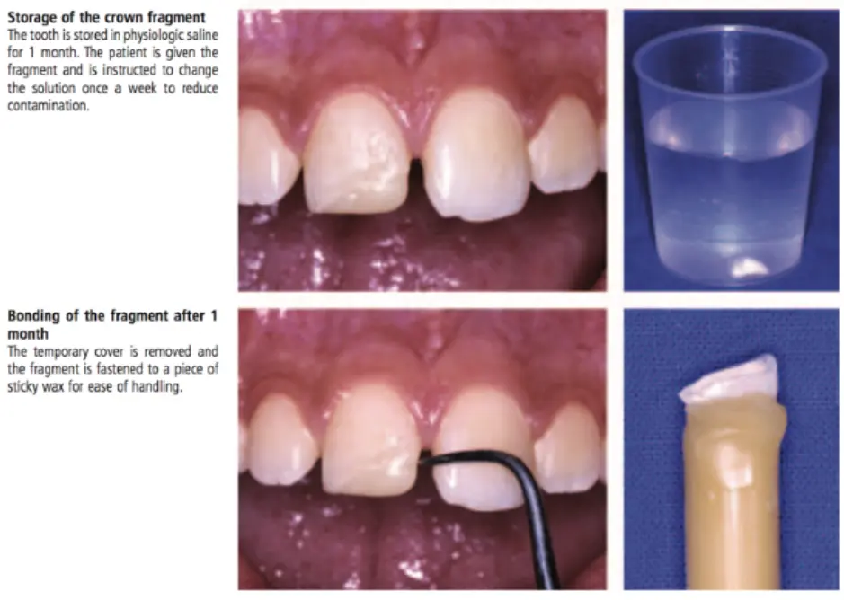 Dentoalveolar Trauma 1-1765348895399.webp