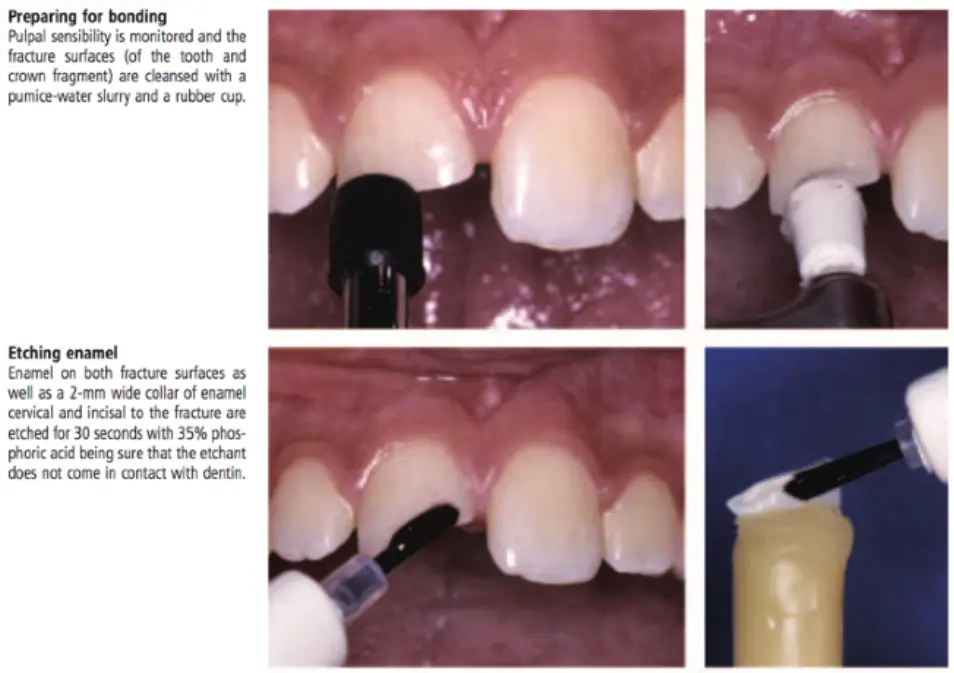 Dentoalveolar Trauma 1-1765348904766.webp