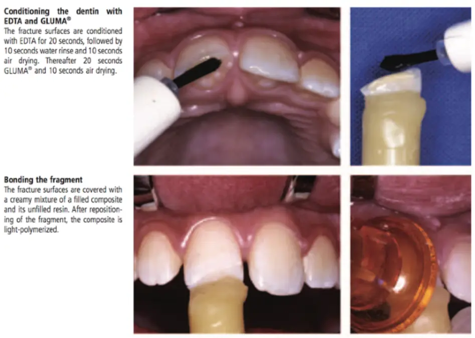 Dentoalveolar Trauma 1-1765348912803.webp