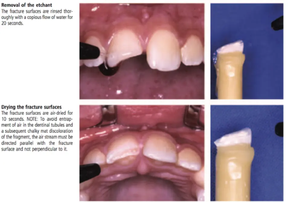 Dentoalveolar Trauma 1-1765349000577.webp