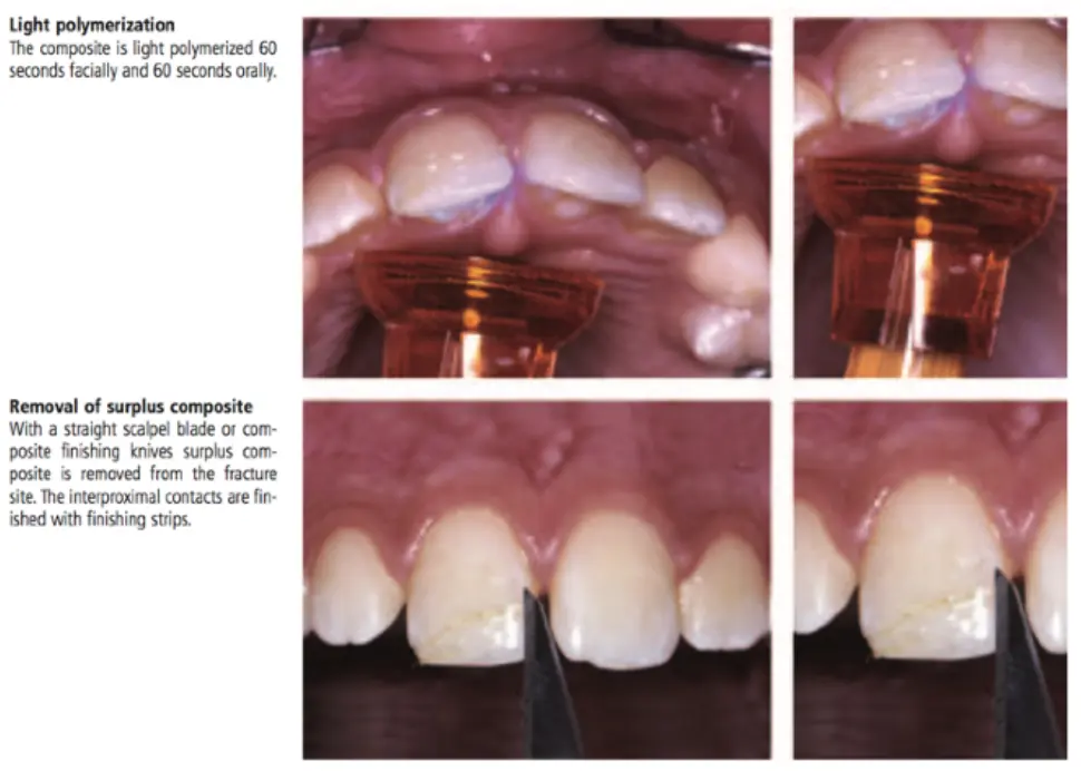 Dentoalveolar Trauma 1-1765349008737.webp