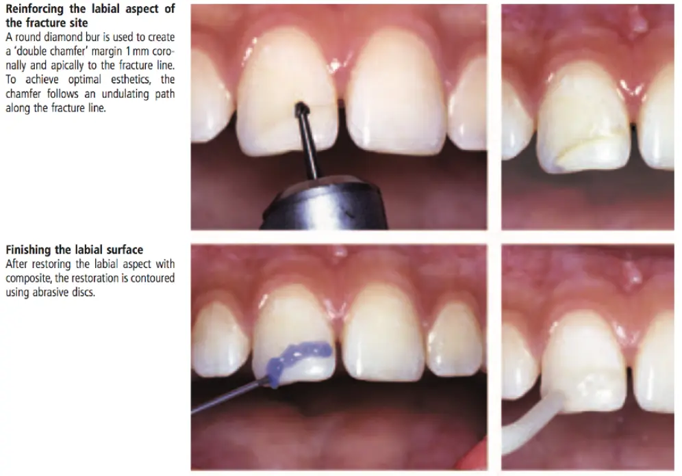 Dentoalveolar Trauma 1-1765349020525.webp