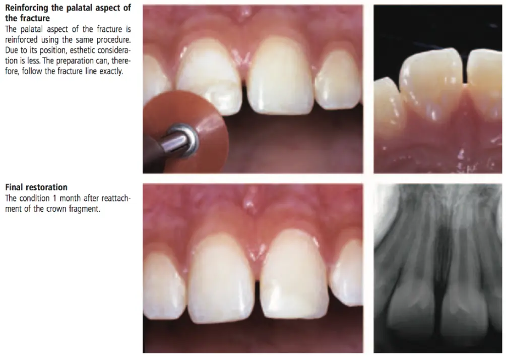Dentoalveolar Trauma 1-1765349029444.webp