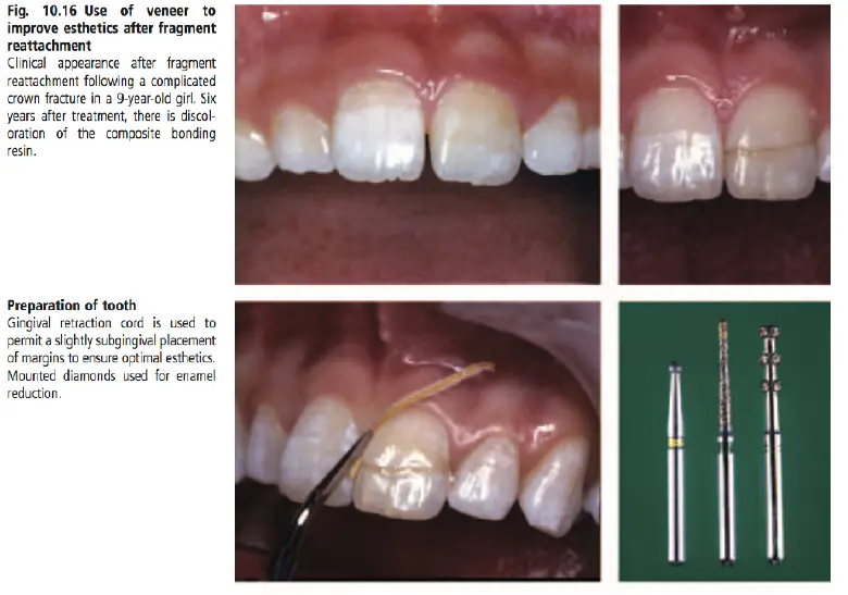 Dentoalveolar Trauma 1-1765349073959.webp