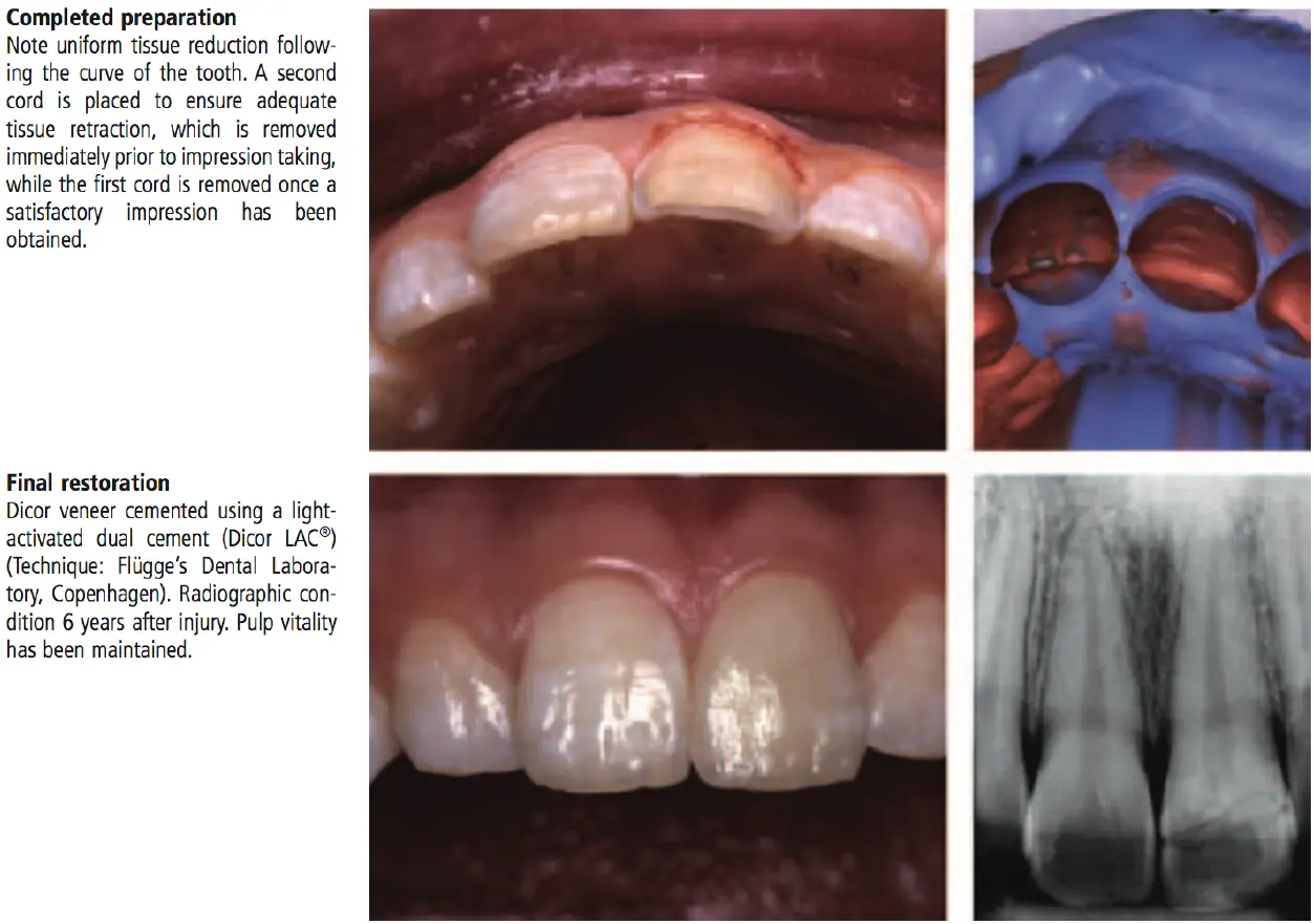 Dentoalveolar Trauma 1-1765349131305.webp