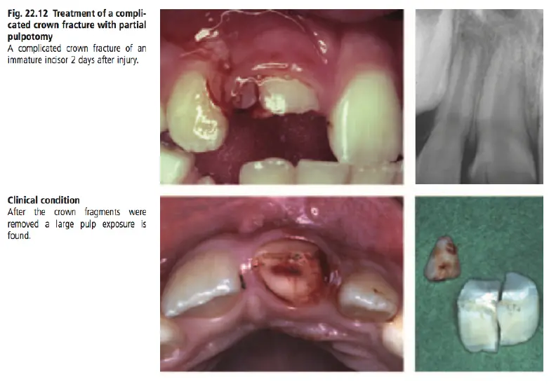 Dentoalveolar Trauma 1-1765349712211.webp