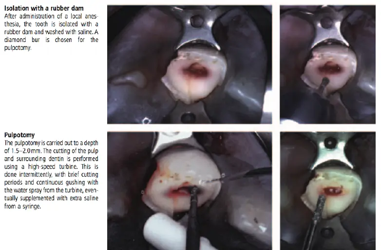 Dentoalveolar Trauma 1-1765349717865.webp
