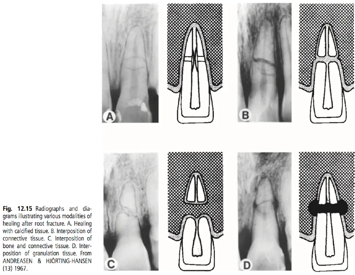 Dentoalveolar Trauma-1765350265611.webp