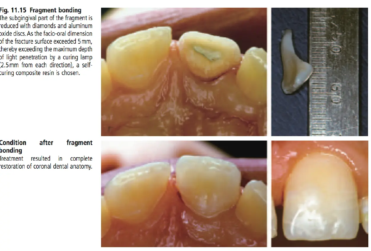 Dentoalveolar Trauma-1765350698383.webp