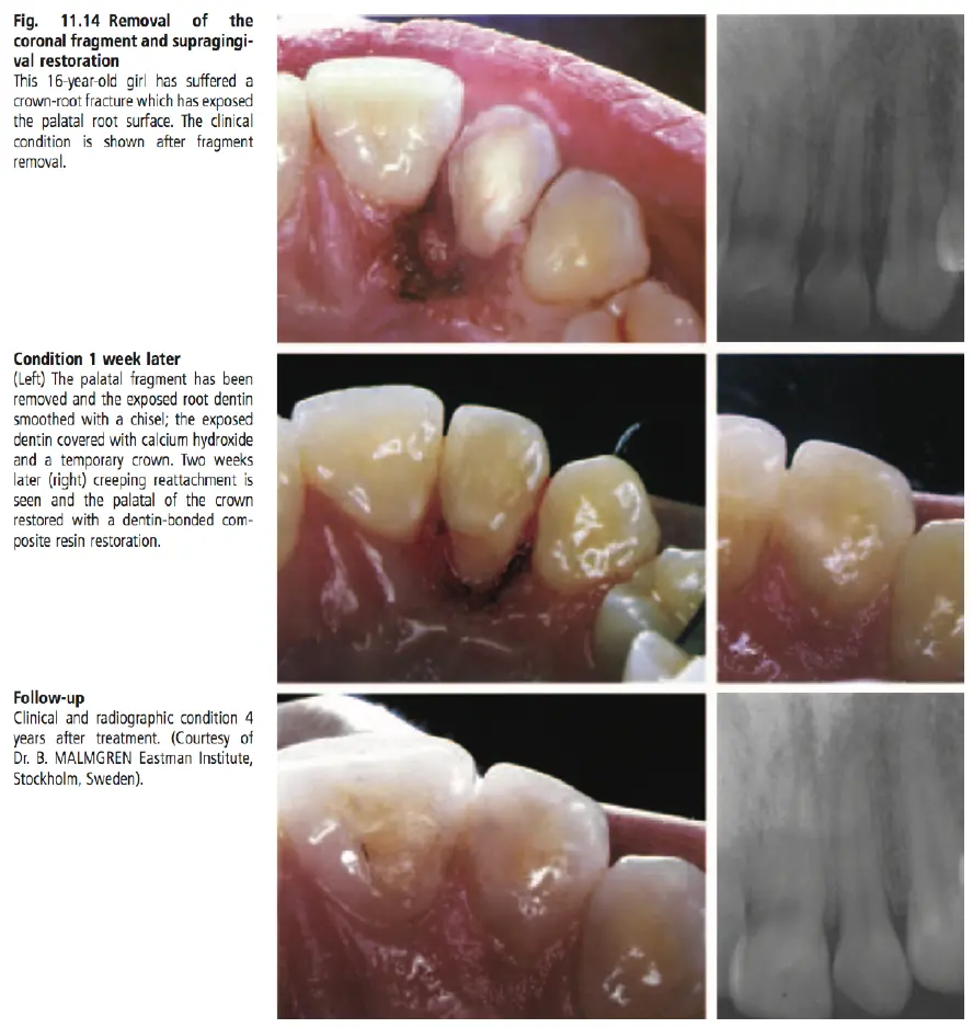 Dentoalveolar Trauma-1765350708380.webp