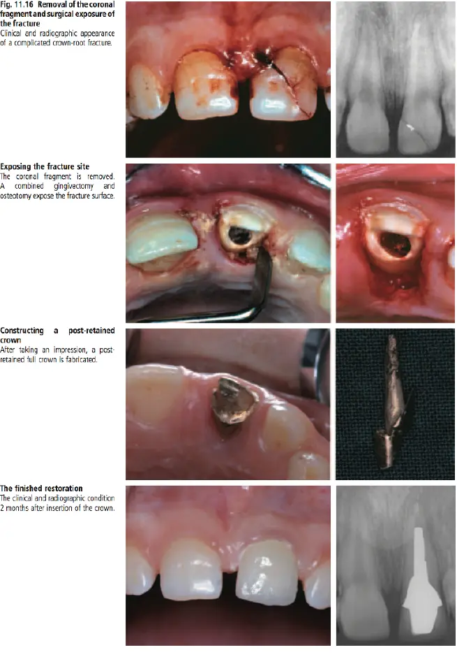 Dentoalveolar Trauma-1765350746873.webp